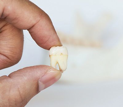 Tooth Extractions Tooth Extractions